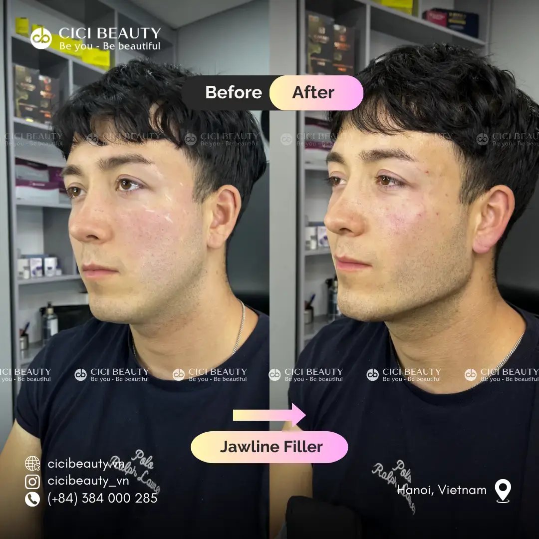 Jawline Filler