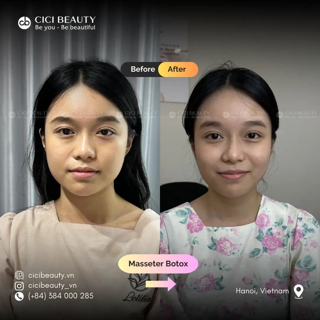 Masseter
