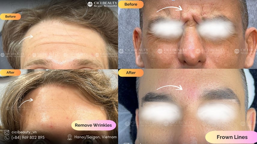 Dermal Fillers-1