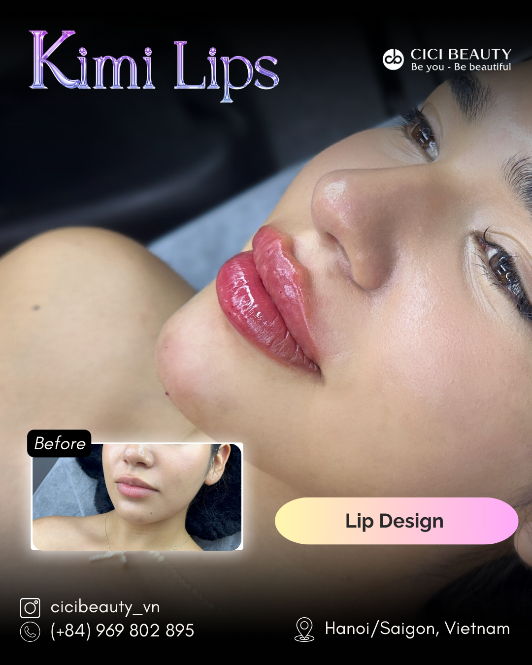 Lip Filler