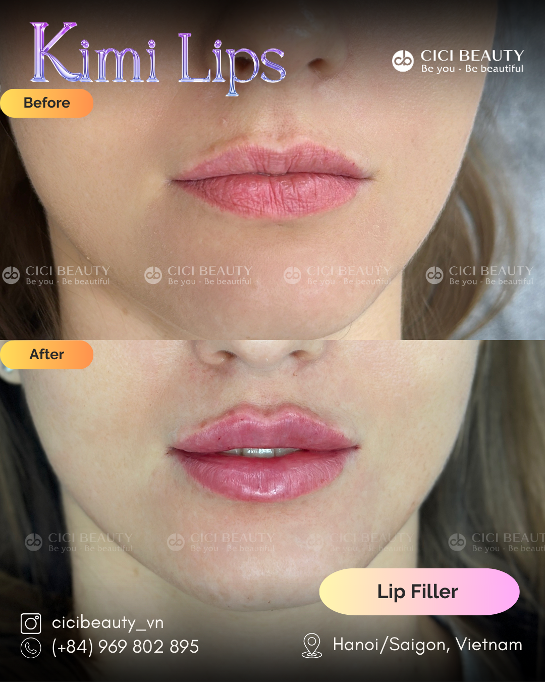 Lips Filler