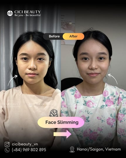 PBA_Masseter_Nhu Ngoc_1