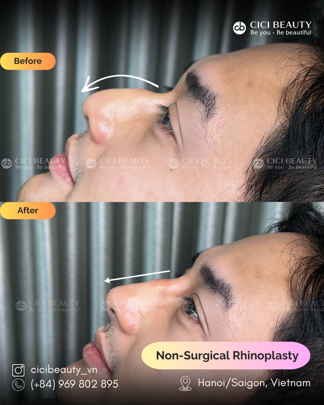 Nose Filler