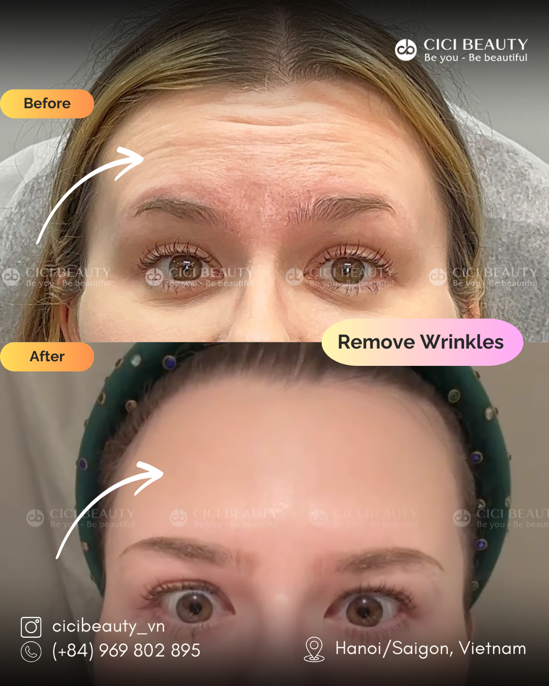 PBA_RemoveWrinkles_Wilma_1