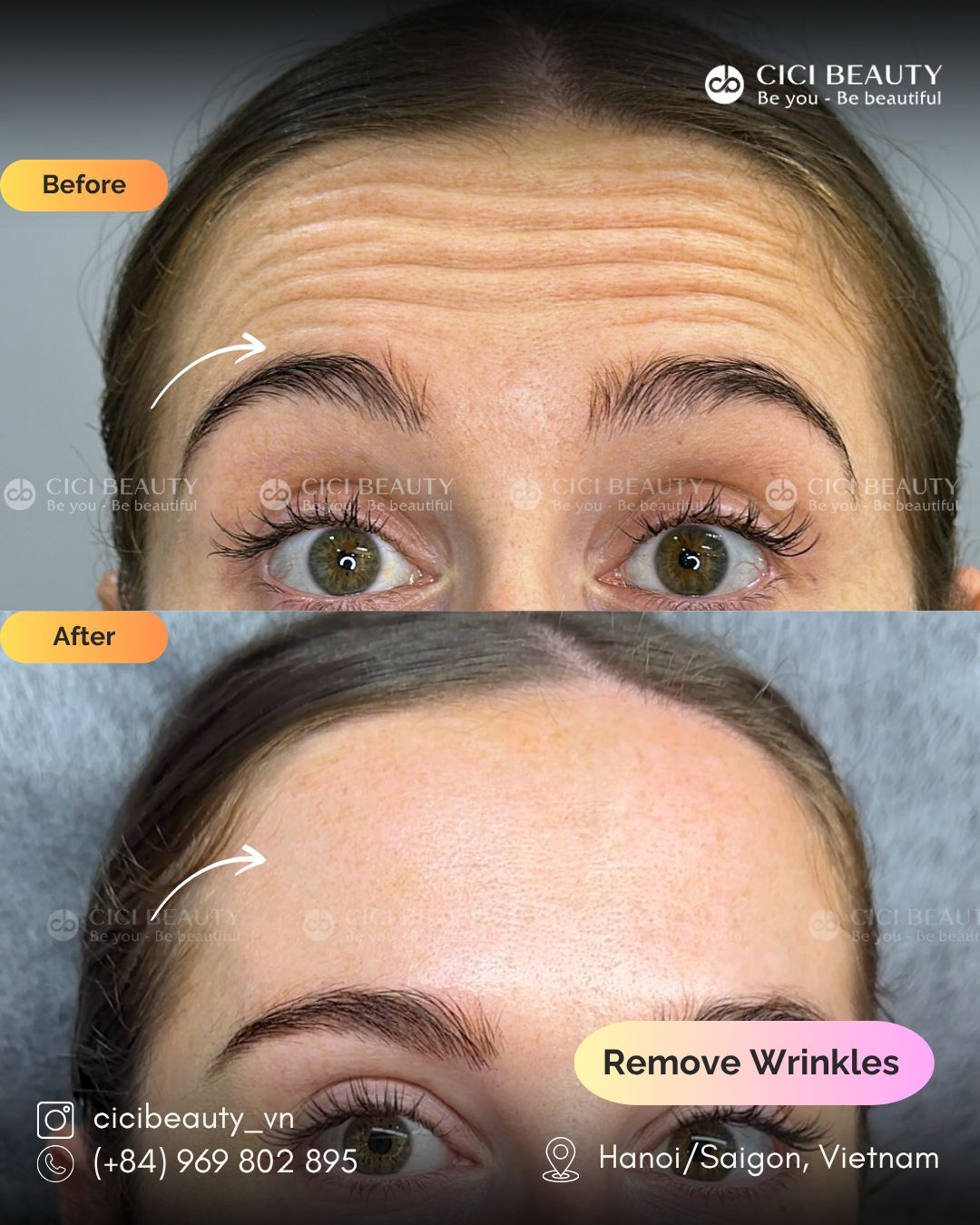 forehead wrinkles before and after