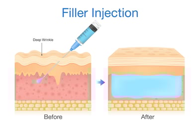 dermal filler explained