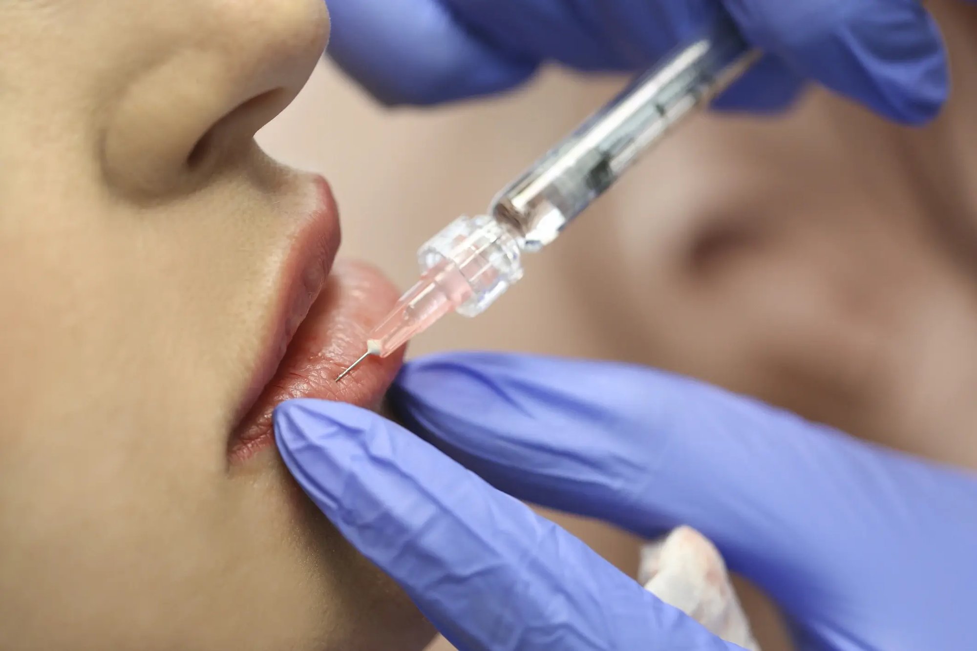lip-filler-injecting